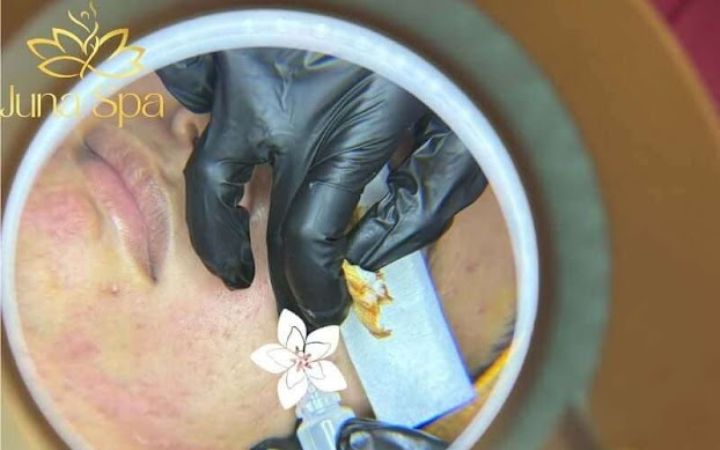 Chăm sóc da trong 72 giờ sau lấy nhân mụn